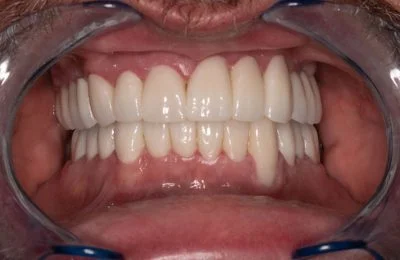 After — fixed, natural-looking teeth after implant treatment at Circle Dental Group