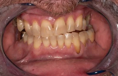 Before — patient before full-arch implant treatment at Circle Dental Group