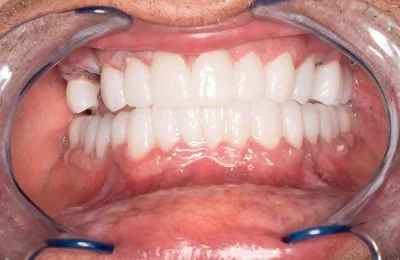 After — fixed, natural-looking teeth after implant treatment at Circle Dental Group