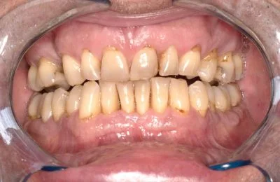 Before — patient before full-arch implant treatment at Circle Dental Group