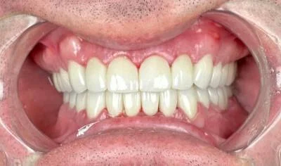 After — fixed, natural-looking teeth after implant treatment at Circle Dental Group