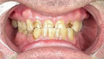 Before — patient before full-arch implant treatment at Circle Dental Group