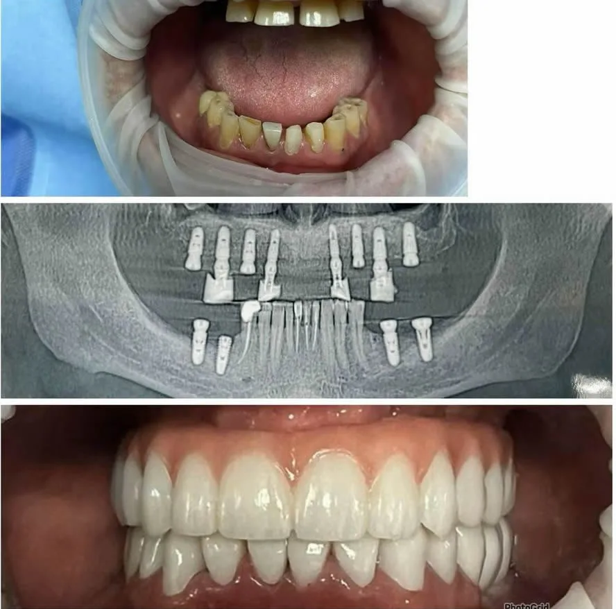 Zirconia crown bridge result at Innova Dental