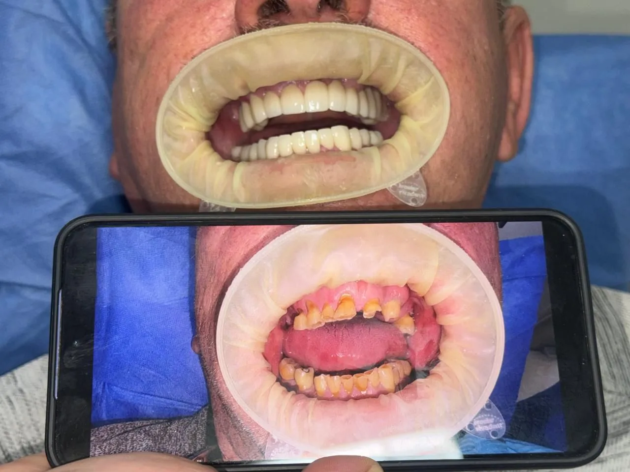 Crown and restoration work at Innova Dental Los Algodones