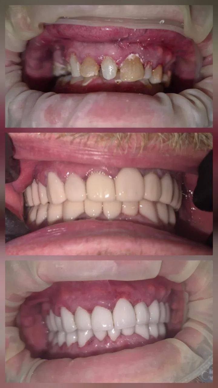 Zirconia crowns close-up result, Innova Dental Molar City