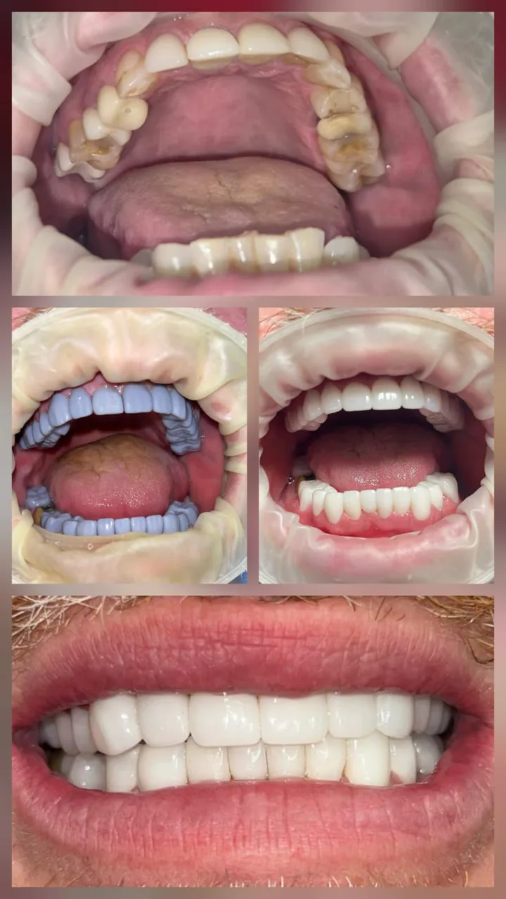 Natural white smile after zirconia crowns at Innova Dental, Los Algodones