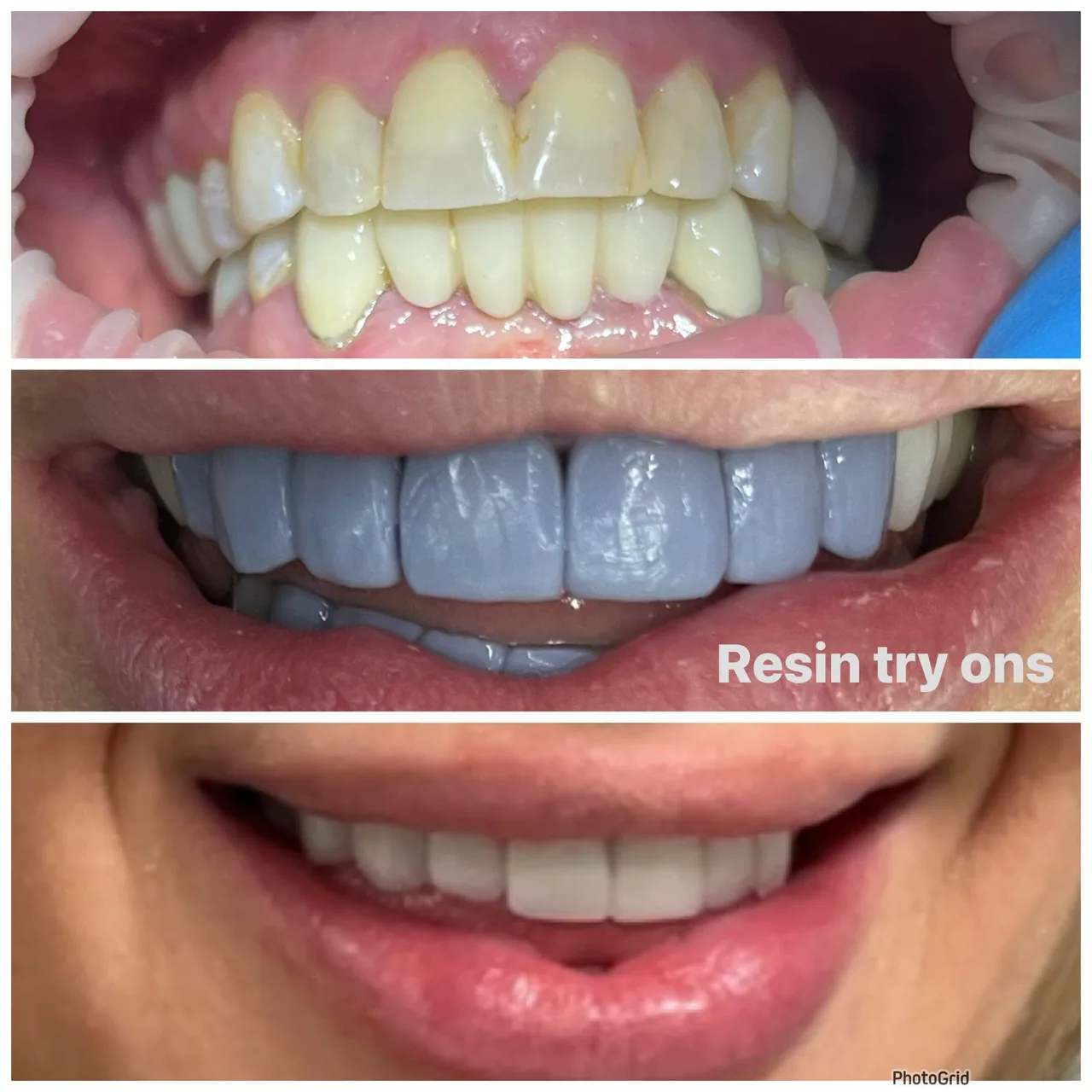 Metal-free zirconia crown smile makeover Los Algodones
