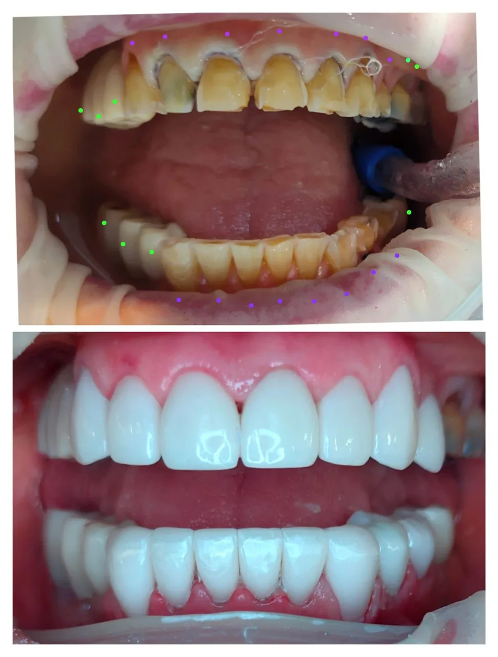 Full smile restoration with zirconia at Innova Dental