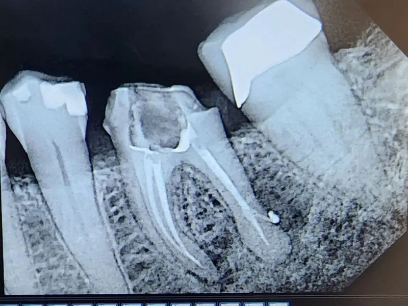 Digital X-ray showing root canal tooth anatomy on monitor