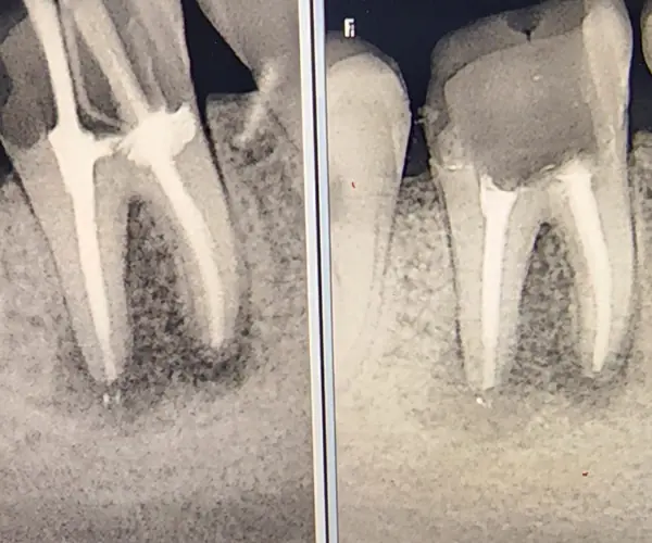 Cross-section diagram of a tooth showing enamel, dentin, pulp chamber, root canals, nerve, and surrounding bone