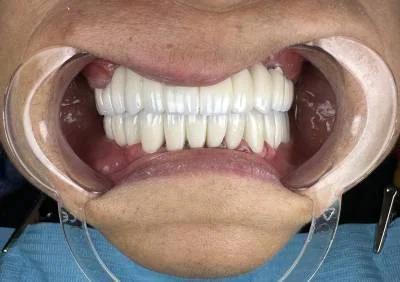 After — natural-looking smile after premium zirconia crowns at Circle Dental Group