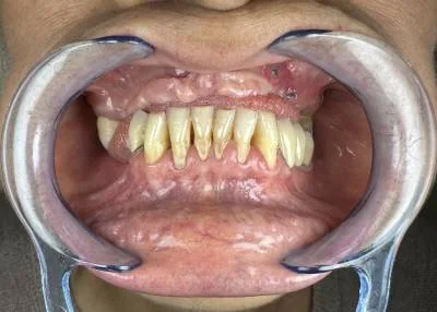 Before — patient smile before treatment at Circle Dental Group, Los Algodones