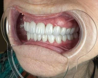 After — natural-looking smile after premium zirconia crowns at Circle Dental Group