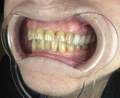 Before — patient smile before treatment at Circle Dental Group, Los Algodones
