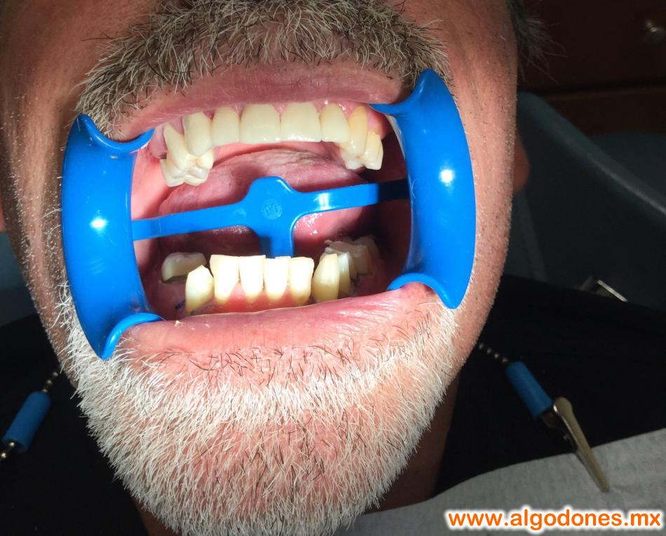 Zirconia crowns 
Dr Fernanda Garcia 