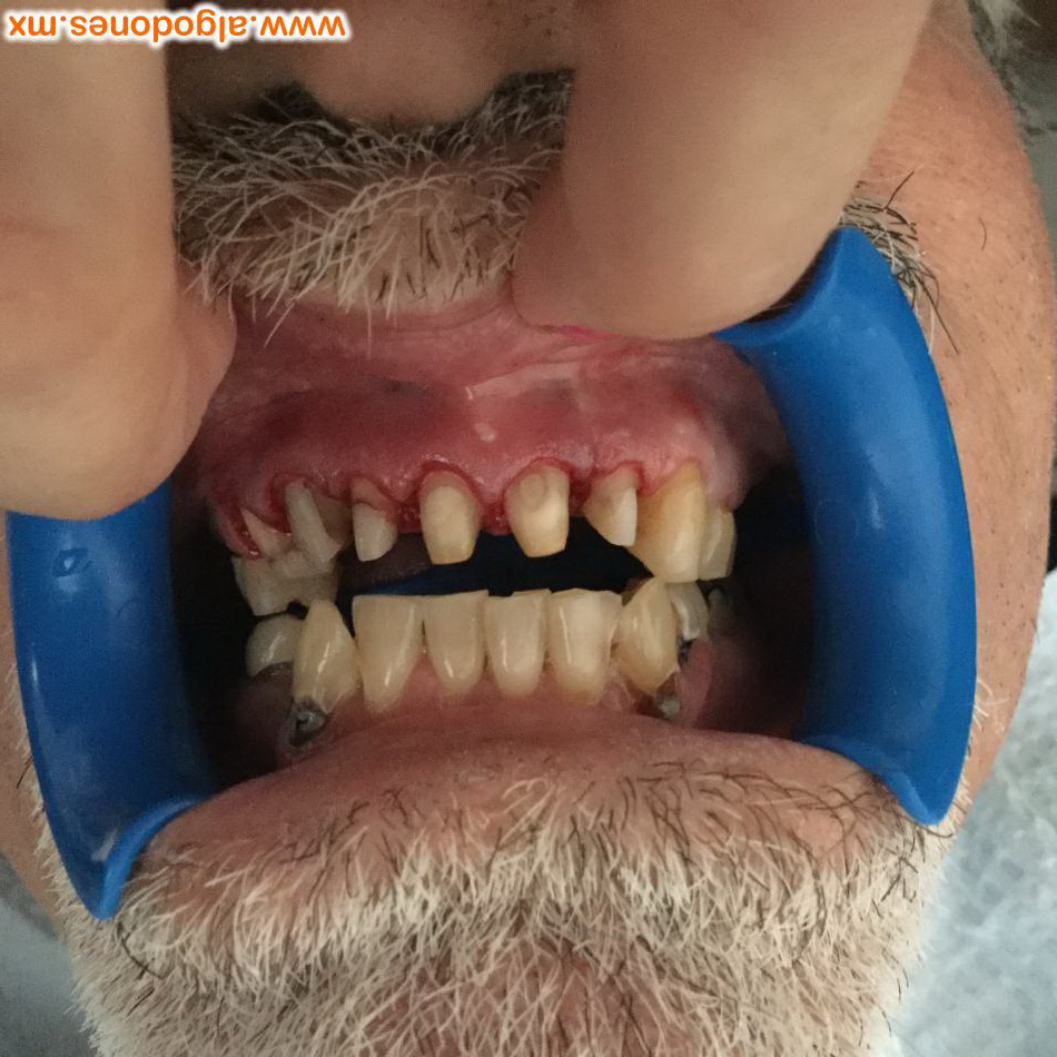 Zirconia crowns 
Dr Fernanda Garcia 