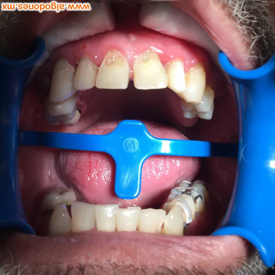 Zirconia crowns 
Dr Fernanda Garcia 